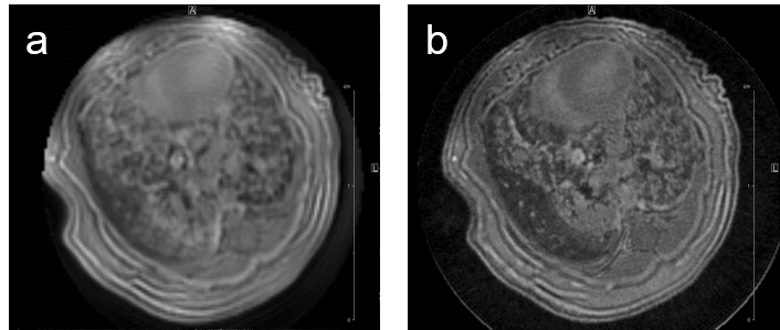 Fig. 5: Mouse lung MRI. Exemplary axial MR-images of a mouse lung with hyperplasia: (a) respiratory-gated UTE-3D sequence with a repetition time of 8.0 ms, echo time of 20 µs, slice thickness/interslice distance: 0.39/0.39 mm, field of view 2.50x2.70x5.00 cm3 and a matrix of 128/128/128 and (b) respiratory-gated ZTE-3D sequence with a repetition time of 4.0 ms, echo time of 0  µs, slice thickness/interslice distance: 0.16/0.16 mm, field of view 3.00x3.00x4.00cm3 and a matrix of 256/256/256. Fig. 5: Mouse lung MRI. Exemplary axial MR-images of a mouse lung with hyperplasia: (a) respiratory-gated UTE-3D sequence with a repetition time of 8.0 ms, echo time of 20 µs, slice thickness/interslice distance: 0.39/0.39 mm, field of view 2.50x2.70x5.00 cm3 and a matrix of 128/128/128 and (b) respiratory-gated ZTE-3D sequence with a repetition time of 4.0 ms, echo time of 0  µs, slice thickness/interslice distance: 0.16/0.16 mm, field of view 3.00x3.00x4.00cm3 and a matrix of 256/256/256.