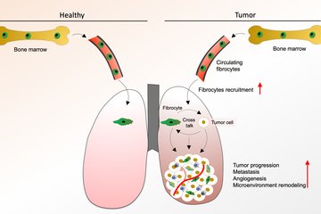 Fibrocytes boost lung tumor development