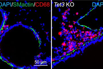 Microscopic view of immune cell infiltration of lungs in mice lacking the TET3 enzyme. Compared to the lungs of control animals (left), immune cells (macrophages, colored red) accumulate in the lungs of mice lacking TET3. Cell nuclei are stained blue, smooth muscle cells green.