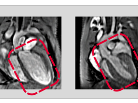 Recycling ist auch im menschlichen Körper wichtig. Ein gestörtes Recycling von Proteinen schädigt die Herzgesundheit.