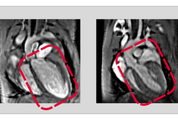 Recycling is also important in the human body: A disrupted protein recycling process can harm heart health.