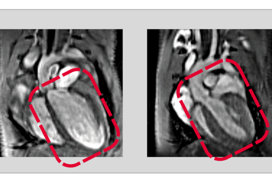Recycling is also important in the human body: A disrupted protein recycling process can harm heart health.